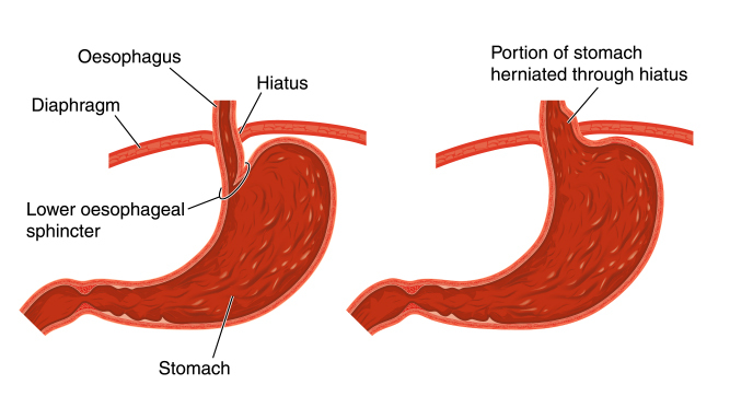 Hiatal Hernia And Normal Anatomy Of The Stomach Stock Illustration ...