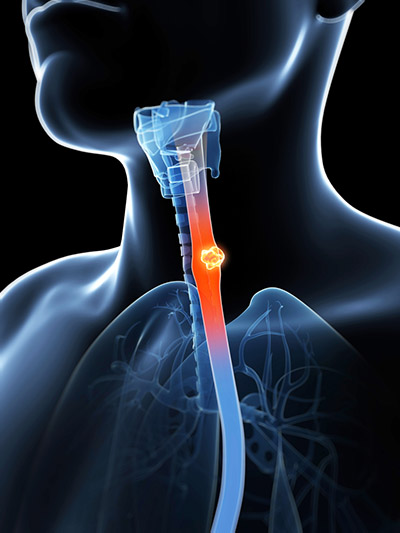 Oesophageal Cancer Surgery London