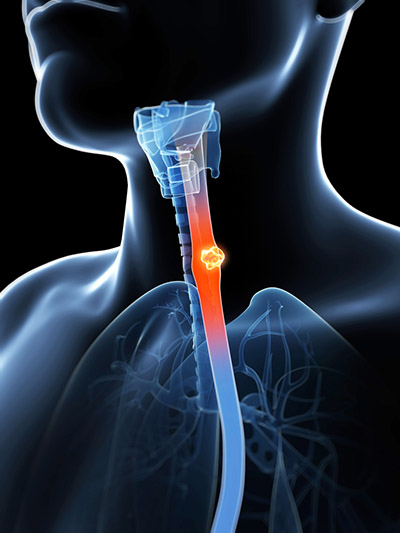 Oesophageal Cancer